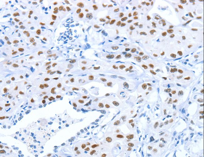 ARID1A / BAF250 Antibody - Immunohistochemistry of paraffin-embedded Human gastric cancer using ARID1A Polyclonal Antibody at dilution of 1:80.