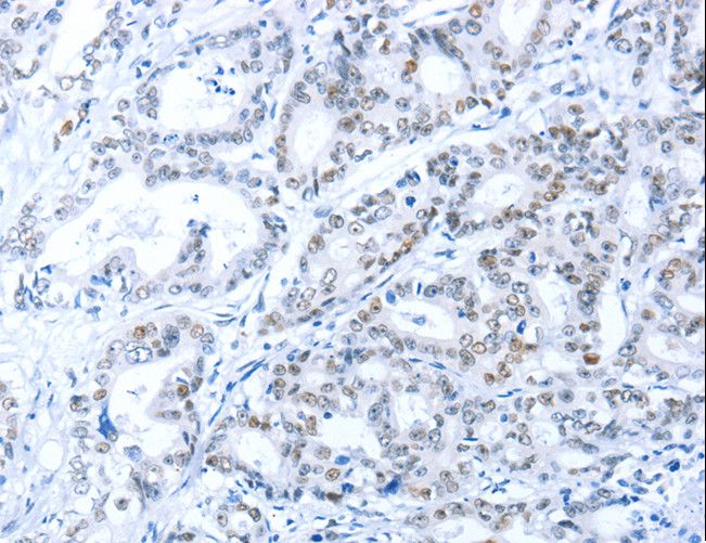 ARID1A / BAF250 Antibody - Immunohistochemistry of paraffin-embedded Human gastric cancer using ARID1A Polyclonal Antibody at dilution of 1:80.