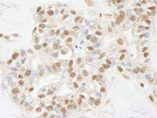 ARID1B / BAF250B Antibody - Detection of Human ARID1B by Immunohistochemistry. Sample: FFPE section of human breast carcinoma. Antibody: Affinity purified rabbit anti-ARID1B used at a dilution of 1:250.