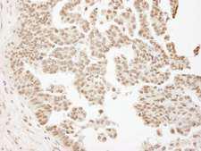 ARID1B / BAF250B Antibody - Detection of Human ARID1B by Immunohistochemistry. Sample: FFPE section of human ovarian carcinoma. Antibody: Affinity purified rabbit anti-ARID1B used at a dilution of 1:1000 (1 ug/ml).