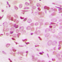 ARID1B / BAF250B Antibody - Immunohistochemical analysis of BAF250B staining in human breast cancer formalin fixed paraffin embedded tissue section. The section was pre-treated using heat mediated antigen retrieval with sodium citrate buffer (pH 6.0). The section was then incubated with the antibody at room temperature and detected using an HRP conjugated compact polymer system. DAB was used as the chromogen. The section was then counterstained with hematoxylin and mounted with DPX.
