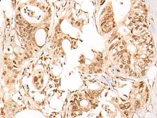 ARID1B / BAF250B Antibody - Immunohistochemistry of paraffin-embedded Human colorectal cancer tissue  using ARID1B Polyclonal Antibody at dilution of 1:40(×200)