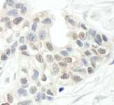 ARID2 Antibody - Detection of Human ARID2 by Immunohistochemistry. Sample: FFPE section of human breast carcinoma. Antibody: Affinity purified rabbit anti-ARID2 used at a dilution of 1:1000 (1 ug/ml).