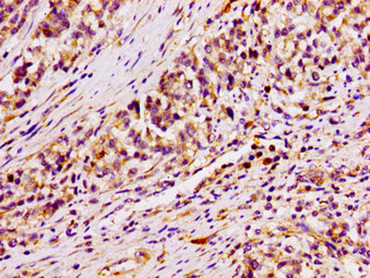 ARID3A / DRIL1 Antibody - Immunohistochemistry image at a dilution of 1:100 and staining in paraffin-embedded human colon cancer performed on a Leica BondTM system. After dewaxing and hydration, antigen retrieval was mediated by high pressure in a citrate buffer (pH 6.0) . Section was blocked with 10% normal goat serum 30min at RT. Then primary antibody (1% BSA) was incubated at 4 °C overnight. The primary is detected by a biotinylated secondary antibody and visualized using an HRP conjugated SP system.
