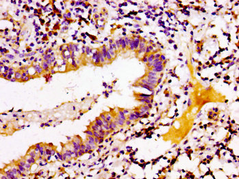 ARID3A / DRIL1 Antibody - Immunohistochemistry image at a dilution of 1:100 and staining in paraffin-embedded human lung cancer performed on a Leica BondTM system. After dewaxing and hydration, antigen retrieval was mediated by high pressure in a citrate buffer (pH 6.0) . Section was blocked with 10% normal goat serum 30min at RT. Then primary antibody (1% BSA) was incubated at 4 °C overnight. The primary is detected by a biotinylated secondary antibody and visualized using an HRP conjugated SP system.