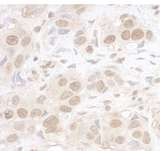 ARID3B Antibody - Detection of Human ARID3B by Immunohistochemistry. Sample: FFPE section of human breast carcinoma. Antibody: Affinity purified rabbit anti-ARID3B used at a dilution of 1:1000 (1 ug/ml).