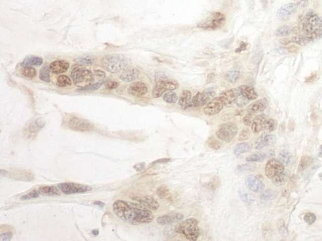 ARID3B Antibody - Detection of Human ARID3B by Immunohistochemistry. Sample: FFPE section of human ovarian carcinoma. Antibody: Affinity purified rabbit anti-ARID3B used at a dilution of 1:1000 (1 ug/ml).