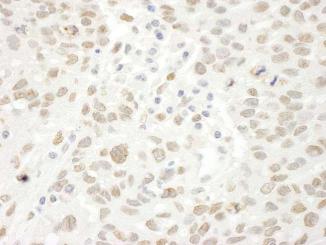 ARID4B Antibody - Detection of Human ARID4B by Immunohistochemistry. Sample: FFPE section of human ovarian carcinoma. Antibody: Affinity purified rabbit anti-ARID4B used at a dilution of 1:250.