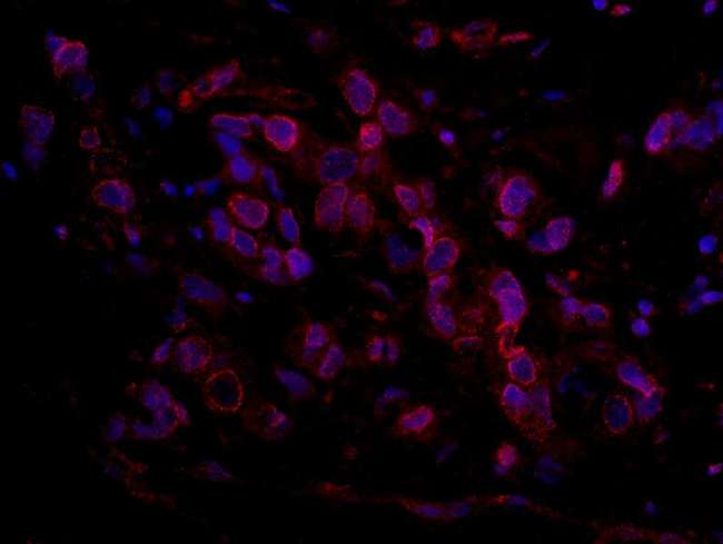 ARID4B Antibody - Detection of Human ARID4B by Immunohistochemistry. Sample: FFPE section of human ovarian carcinoma. Antibody: Affinity purified rabbit anti-ARID4B used at a dilution of 1:100. Detection: Red-fluorescent Goat anti-Rabbit IgG-heavy and light chain cross-adsorbed Antibody DyLight 594 Conjugated (A120-601D4) used at a dilution of 1:100.