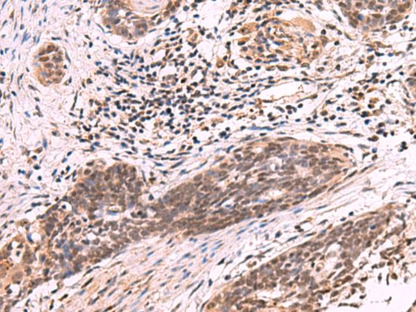 ARIH2 Antibody - Immunohistochemistry of paraffin-embedded Human esophagus cancer tissue  using ARIH2 Polyclonal Antibody at dilution of 1:80(×200)