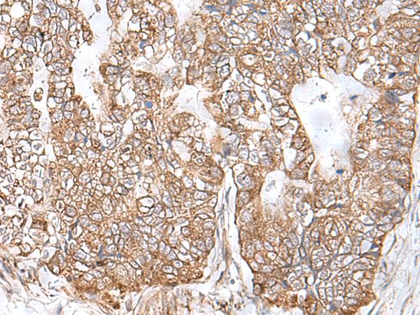Arkadia / RNF111 Antibody - Immunohistochemistry of paraffin-embedded Human gastric cancer tissue  using RNF111 Polyclonal Antibody at dilution of 1:50(×200)