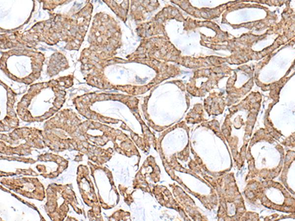Arkadia / RNF111 Antibody - Immunohistochemistry of paraffin-embedded Human thyroid cancer tissue  using RNF111 Polyclonal Antibody at dilution of 1:50(×200)