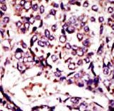 ARL1 Antibody - Formalin-fixed and paraffin-embedded human cancer tissue reacted with the primary antibody, which was peroxidase-conjugated to the secondary antibody, followed by DAB staining. This data demonstrates the use of this antibody for immunohistochemistry; clinical relevance has not been evaluated. BC = breast carcinoma; HC = hepatocarcinoma.
