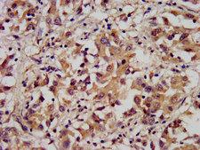 ARL1 Antibody - Immunohistochemistry image at a dilution of 1:300 and staining in paraffin-embedded human liver cancer performed on a Leica BondTM system. After dewaxing and hydration, antigen retrieval was mediated by high pressure in a citrate buffer (pH 6.0) . Section was blocked with 10% normal goat serum 30min at RT. Then primary antibody (1% BSA) was incubated at 4 °C overnight. The primary is detected by a biotinylated secondary antibody and visualized using an HRP conjugated SP system.