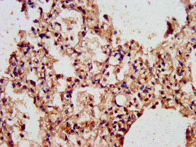ARL1 Antibody - Immunohistochemistry image at a dilution of 1:300 and staining in paraffin-embedded human lung tissue performed on a Leica BondTM system. After dewaxing and hydration, antigen retrieval was mediated by high pressure in a citrate buffer (pH 6.0) . Section was blocked with 10% normal goat serum 30min at RT. Then primary antibody (1% BSA) was incubated at 4 °C overnight. The primary is detected by a biotinylated secondary antibody and visualized using an HRP conjugated SP system.