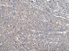 ARL1 Antibody - Immunohistochemistry of paraffin-embedded Human liver cancer tissue  using ARL1 Polyclonal Antibody at dilution of 1:50(×200)