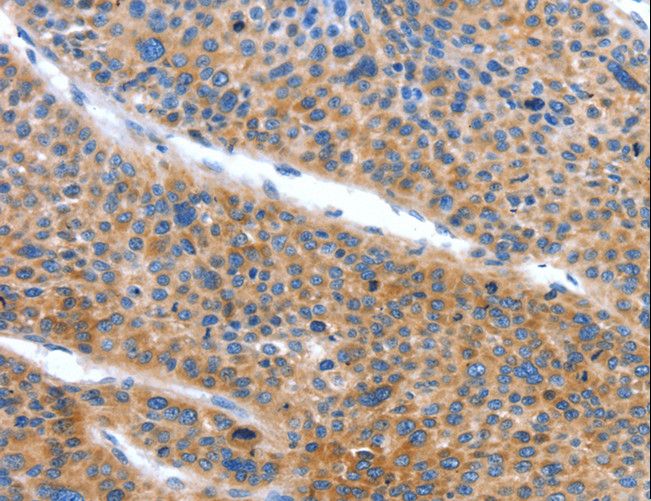 ARL11 Antibody - Immunohistochemistry of paraffin-embedded Human lung cancer using ARL11 Polyclonal Antibody at dilution of 1:50.