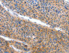 ARL11 Antibody - Immunohistochemistry of paraffin-embedded Human lung cancer using ARL11 Polyclonal Antibody at dilution of 1:50.