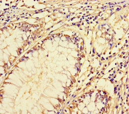 ARL16 Antibody - Immunohistochemistry of paraffin-embedded human colon cancer using ARL16 Antibody at dilution of 1:100