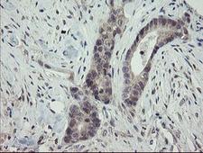 ARL2BP / BART Antibody - IHC of paraffin-embedded Adenocarcinoma of Human colon tissue using anti-ARL2BP mouse monoclonal antibody.