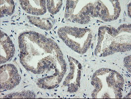 ARL2BP / BART Antibody - IHC of paraffin-embedded Carcinoma of Human prostate tissue using anti-ARL2BP mouse monoclonal antibody.