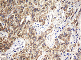 ARL2BP / BART Antibody - IHC of paraffin-embedded Carcinoma of Human kidney tissue using anti-ARL2BP mouse monoclonal antibody. (Heat-induced epitope retrieval by 10mM citric buffer, pH6.0, 100C for 10min).