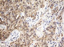 ARL2BP / BART Antibody - IHC of paraffin-embedded Carcinoma of Human kidney tissue using anti-ARL2BP mouse monoclonal antibody. (Heat-induced epitope retrieval by 10mM citric buffer, pH6.0, 100C for 10min).