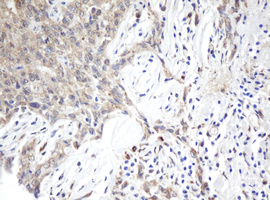 ARL2BP / BART Antibody - IHC of paraffin-embedded Carcinoma of Human kidney tissue using anti-ARL2BP mouse monoclonal antibody.