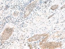 ARL2BP / BART Antibody - Immunohistochemistry of paraffin-embedded Human esophagus cancer tissue  using ARL2BP Polyclonal Antibody at dilution of 1:50(×200)