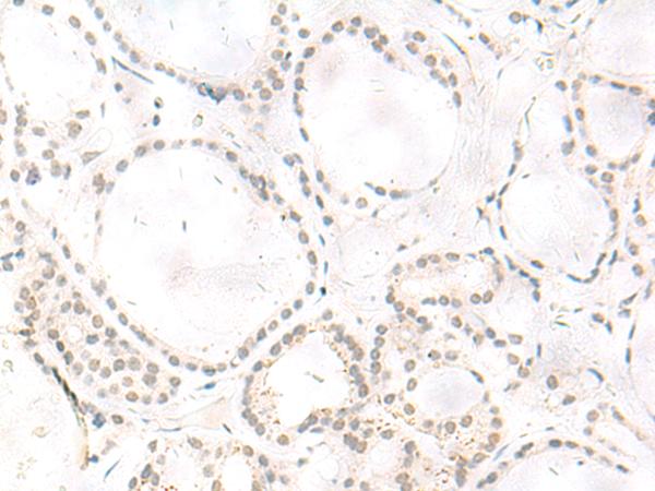 ARL2BP / BART Antibody - Immunohistochemistry of paraffin-embedded Human thyroid cancer tissue  using ARL2BP Polyclonal Antibody at dilution of 1:50(×200)