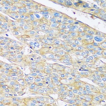 ARL4A / ARL4 Antibody - Immunohistochemistry of paraffin-embedded Human liver cancer using ARL4A Polyclonal Antibody at dilution of 1:100 (40x lens).