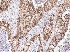 ARL4A / ARL4 Antibody - Immunochemical staining of human ARL4A in human colon carcinoma with rabbit polyclonal antibody at 1:1000 dilution, formalin-fixed paraffin embedded sections.