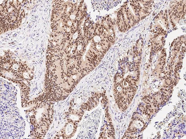 ARL4A / ARL4 Antibody - Immunochemical staining of human ARL4A in human colon carcinoma with rabbit polyclonal antibody at 1:1000 dilution, formalin-fixed paraffin embedded sections.