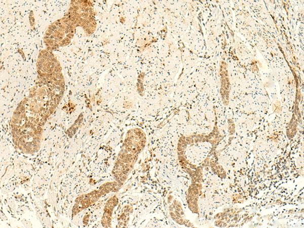ARL4D Antibody - Immunohistochemistry of paraffin-embedded Human esophagus cancer tissue  using ARL4D Polyclonal Antibody at dilution of 1:50(×200)
