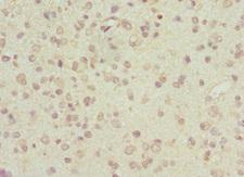 ARL6 Antibody - Immunohistochemistry of paraffin-embedded human glioma cancer at dilution 1:100