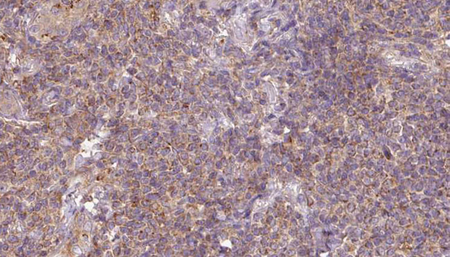 ARL6 Antibody - 1:100 staining human lymph carcinoma tissue by IHC-P. The sample was formaldehyde fixed and a heat mediated antigen retrieval step in citrate buffer was performed. The sample was then blocked and incubated with the antibody for 1.5 hours at 22°C. An HRP conjugated goat anti-rabbit antibody was used as the secondary.