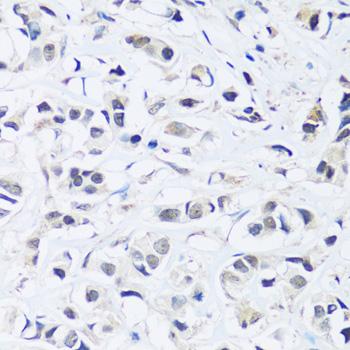 ARL6IP4 Antibody - Immunohistochemistry of paraffin-embedded Human breast cancer using ARL6IP4 Polyclonal Antibody at dilution of 1:100 (40x lens).