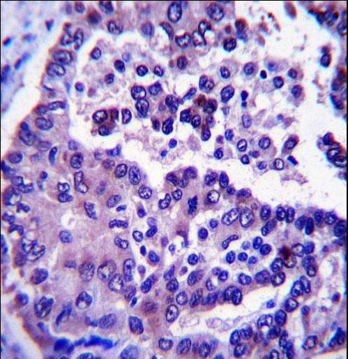 ARL8A Antibody - ARL8A Antibody immunohistochemistry of formalin-fixed and paraffin-embedded human lung adenocarcinoma followed by peroxidase-conjugated secondary antibody and DAB staining.