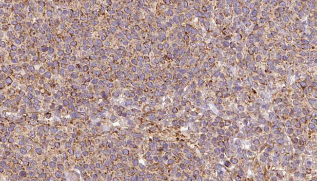 ARL8B Antibody - 1:100 staining human lymph carcinoma tissue by IHC-P. The sample was formaldehyde fixed and a heat mediated antigen retrieval step in citrate buffer was performed. The sample was then blocked and incubated with the antibody for 1.5 hours at 22°C. An HRP conjugated goat anti-rabbit antibody was used as the secondary.