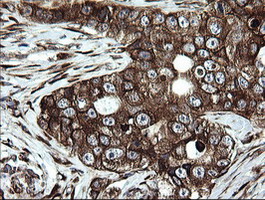 ARMC1 Antibody - IHC of paraffin-embedded Adenocarcinoma of Human breast tissue using anti-ARMC1 mouse monoclonal antibody.