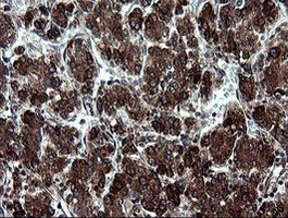 ARMC1 Antibody - IHC of paraffin-embedded Carcinoma of Human liver tissue using anti-ARMC1 mouse monoclonal antibody.