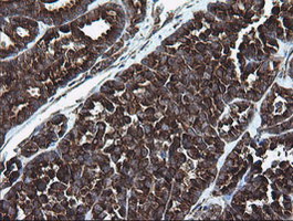ARMC1 Antibody - IHC of paraffin-embedded Carcinoma of Human thyroid tissue using anti-ARMC1 mouse monoclonal antibody.