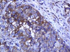 ARMC1 Antibody - IHC of paraffin-embedded Adenocarcinoma of Human colon tissue using anti-ARMC1 mouse monoclonal antibody.