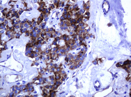 ARMC1 Antibody - IHC of paraffin-embedded Carcinoma of Human pancreas tissue using anti-ARMC1 mouse monoclonal antibody.