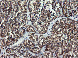 ARMC1 Antibody - IHC of paraffin-embedded Carcinoma of Human thyroid tissue using anti-ARMC1 mouse monoclonal antibody.