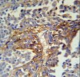 ARMC5 Antibody - ARMC5 Antibody immunohistochemistry of formalin-fixed and paraffin-embedded human skin carcinoma followed by peroxidase-conjugated secondary antibody and DAB staining.