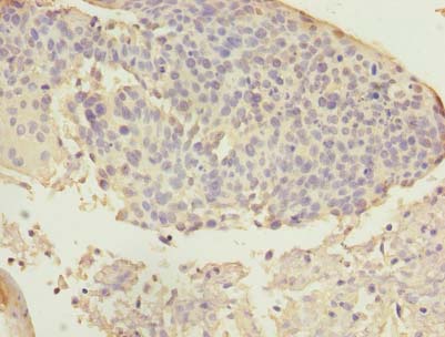 ARMC7 Antibody - Immunohistochemistry of paraffin-embedded human cervical cancer using antibody at dilution of 1:100.