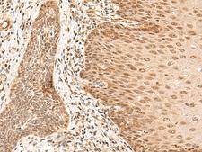 ARMC8 Antibody - Immunohistochemistry of paraffin-embedded Human esophagus cancer tissue  using ARMC8 Polyclonal Antibody at dilution of 1:40(×200)
