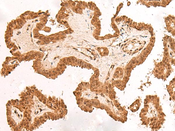 ARMC8 Antibody - Immunohistochemistry of paraffin-embedded Human thyroid cancer tissue  using ARMC8 Polyclonal Antibody at dilution of 1:40(×200)
