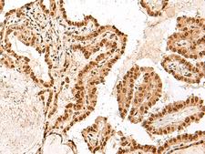 ARMC8 Antibody - Immunohistochemistry of paraffin-embedded Human thyroid cancer tissue  using ARMC8 Polyclonal Antibody at dilution of 1:60(×200)